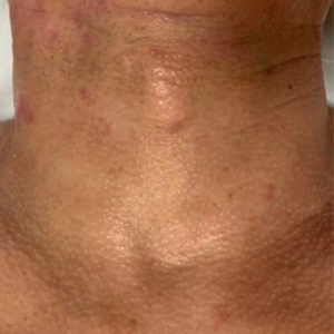 Rides cou apès traitement theramagnetic