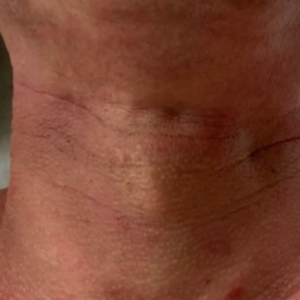 Rides cou avant traitement theramagnetic