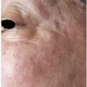 Rides patte d'oie après traitement theramagnetic