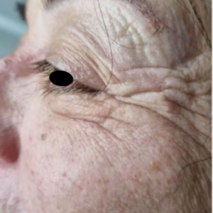 Rides patte d'oie avant traitement theramagnetic