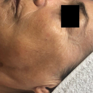 Rides visage après traitement theramagnetic