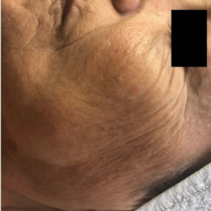 Rides visage avant traitement theramagnetic