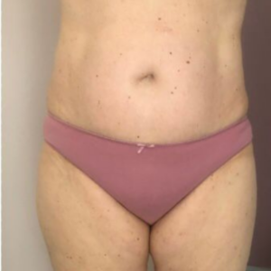 ventre après traitement endomassage