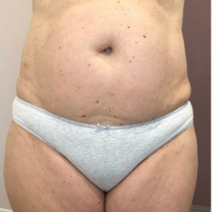 Gros ventre avant traitement endomassage